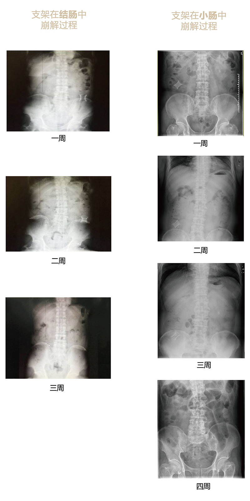 手术崩解过程x光片-01.jpg